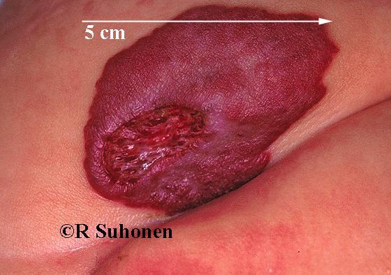 A large capillary haemangioma in the genital region