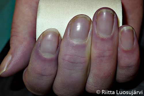 Acrocyanosis of fingers