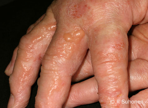 Acute weeping vesicular dermatitis