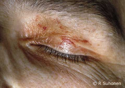 AL amyloidosis in the eyelids