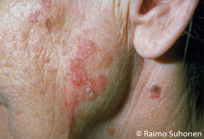Actinic (solar) keratosis on the cheek