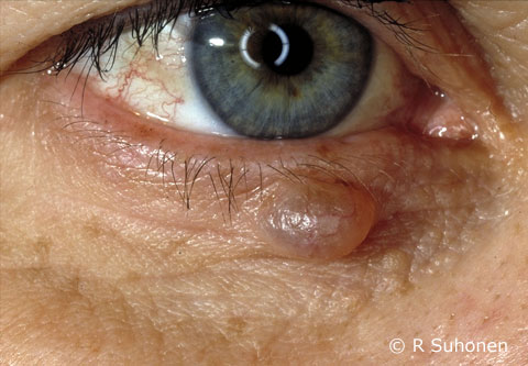 An eccrine cyst in the lower eyelid