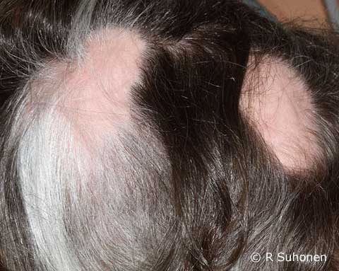 Alopecia areata