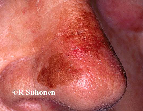 Actinic keratosis on the nose