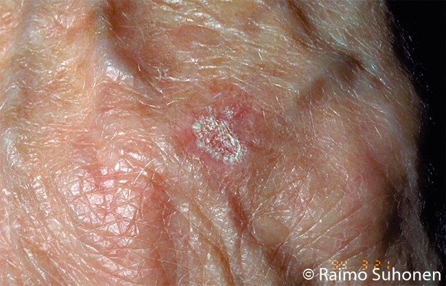 Actinic keratosis on the back of the hand