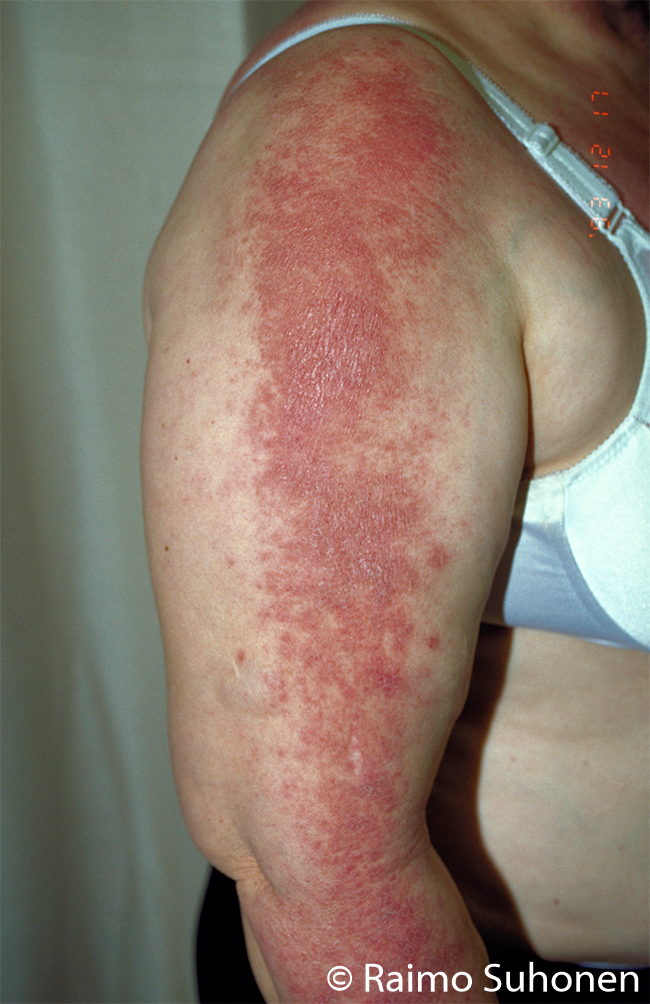 "Dermatomyositis sine myositis" on the arm and shoulder