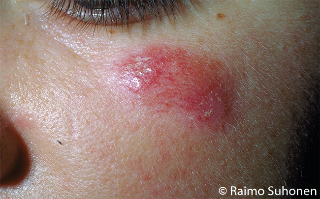 A single DLE lesion on the cheek