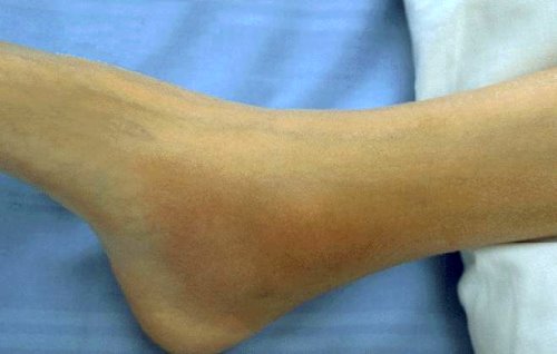 Acute arthritis in the ankle associated with Reiter’s syndrome