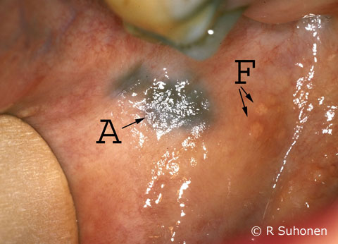 Amalgam stains