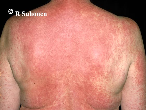 Allergic exanthema