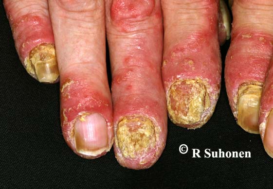 Acrodermatitis continua