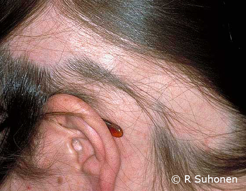 Alopecia areata