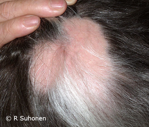  Alopecia areata