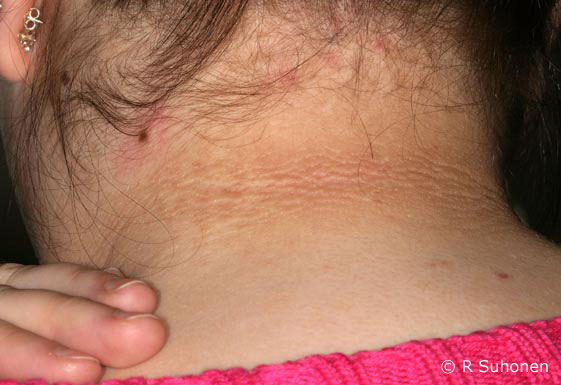 Acanthosis nigricans in the neck