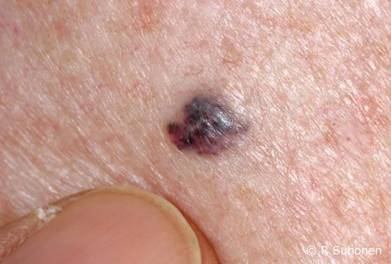 Angiokeratoma