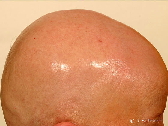 Alopecia universalis