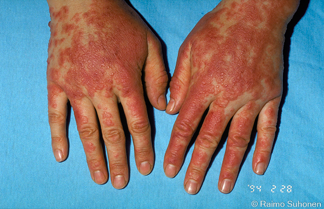 Allergic hand dermatitis (Primula obconica)