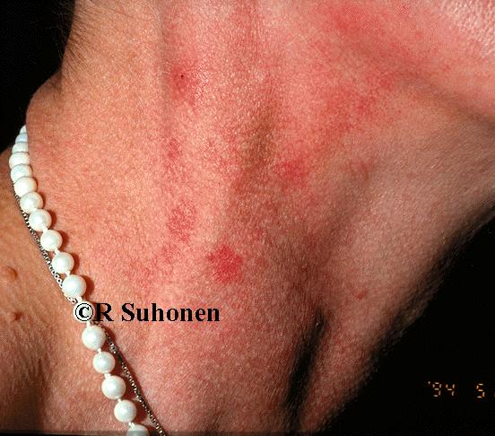 Allergic dermatitis on the neck (nail varnish)