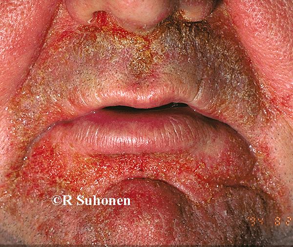 Allergic perioral dermatitis