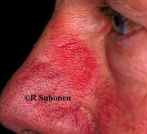 A patch of subacute dermatitis on the side of the nose