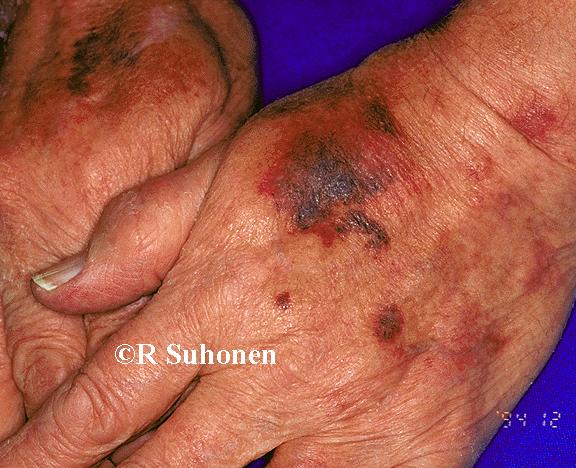 Age atrophy with ecchymoses on the back of the hand