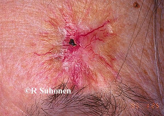 An atrophic, telangiectatic scar caused by ionizing radiation