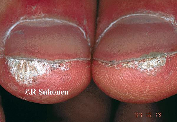 A viral wart under the distal nails of the both thumbs