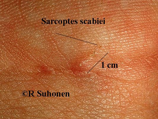 A furrow of scabies mite in the skin of the wrist
