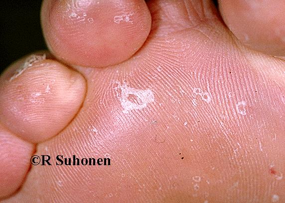 "Dry-type tinea" on plantar skin