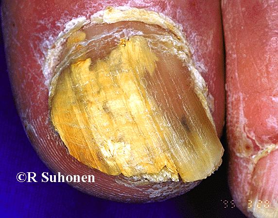 A big toe nail infected by a dermatophyte