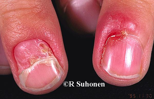 Acute paronychia