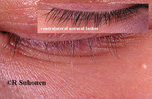 Alopecia areata of the eyelashes