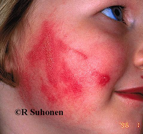 Acute dermatitis