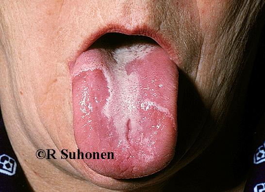"Geographic tongue", glossitis migrans transitoria