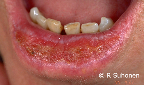 Actinic cheilitis in the lower lip