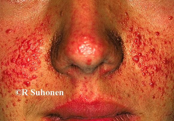 Angiofibromas ("Adenoma sebaceum") on the facial skin