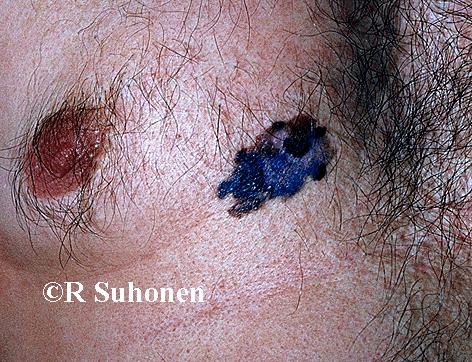 A superficially spreading melanoma on the chest