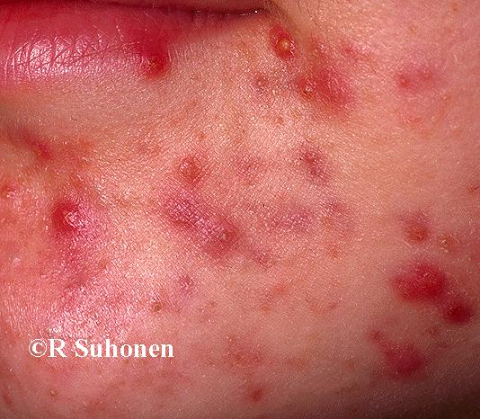 Acne of papulopustular type