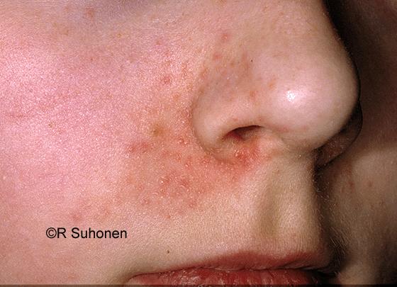 "Perinasal dermatitis"