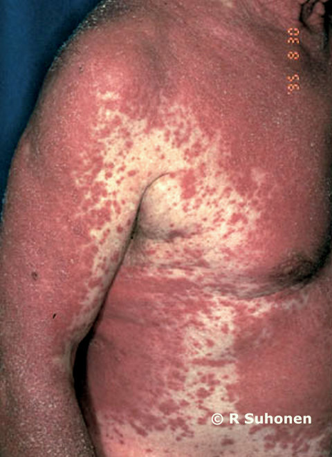 Allergic exanthema caused by carbamazepine