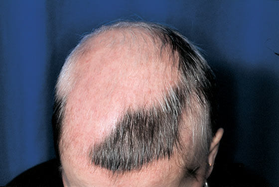 Alopecia areata