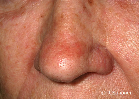 Actinic keratosis on the nose