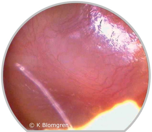 Acute otitis media