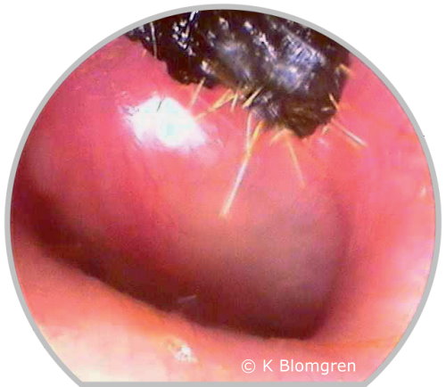 Acute otitis media