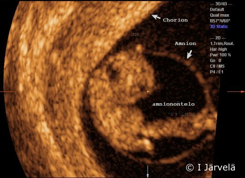 Amnion and chorion (ultrasound scan)