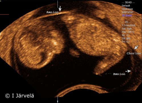 Amnion and chorion (ultrasound scan)