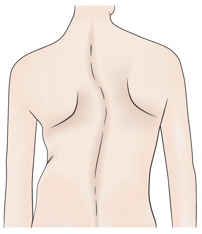 Adolescent idiopathic scoliosis