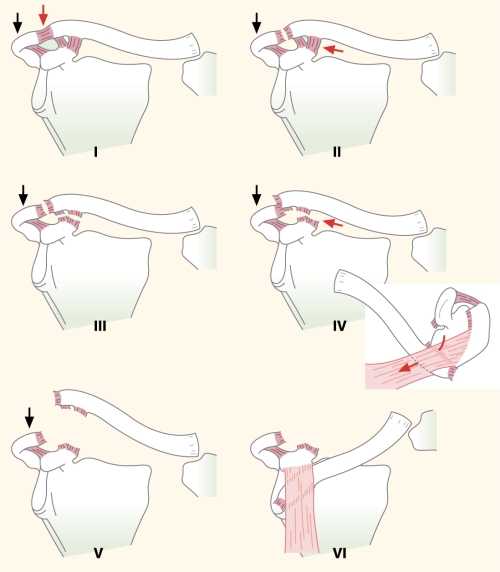 AC joint dislocations: Rockwood classification
