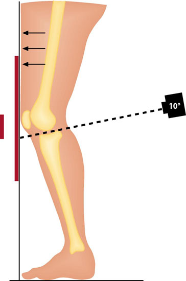 A PA radiograph of the knee is taken in a standing position with the knee slightly flexed, both knees in the same image
