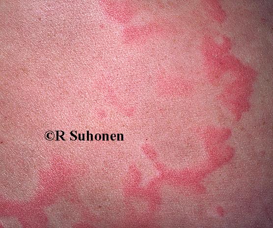 A red urticaria wheal (hives)